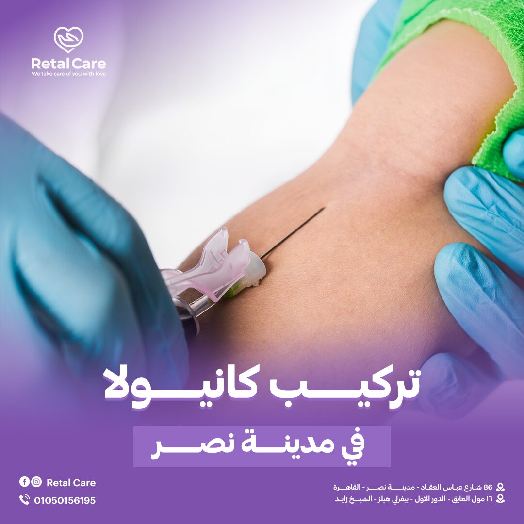 تركيب كانيولا في مدينه نصر